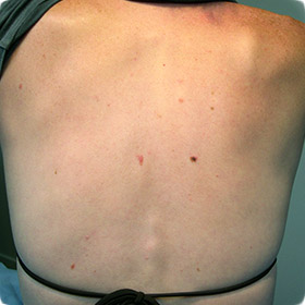 Melanoma in Adults: Condition, Treatments, and Pictures ...