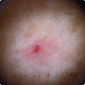 BCC skin cancer - Skinsite's digital imaging picks up the small red lines